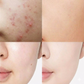 Before and after comparison of acne-prone skin on a person&